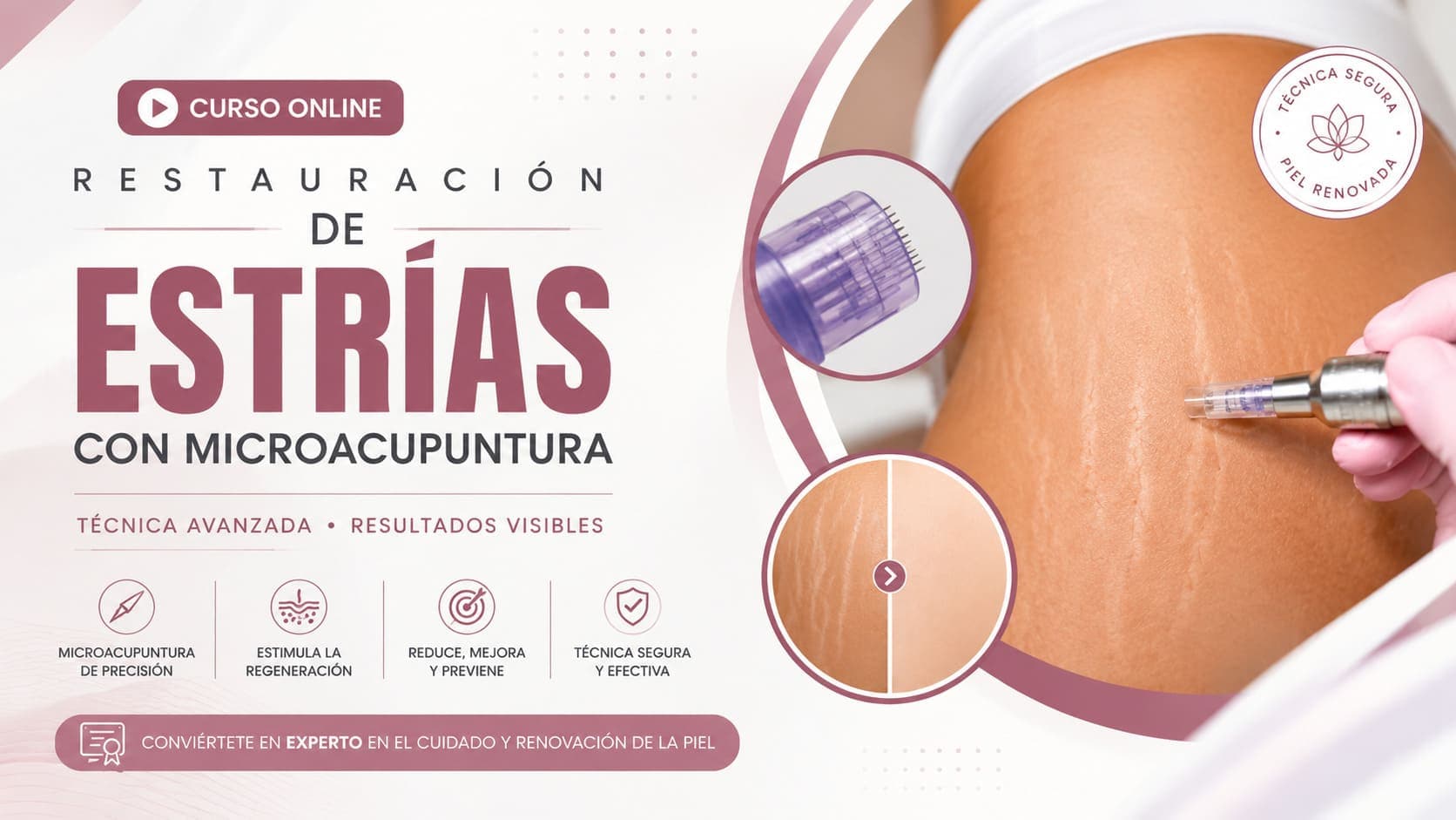 Curso Online de Restauración de Estrías con Microacupuntura